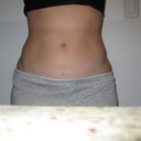 11 days after abs
