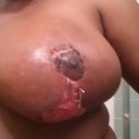 Oct 22nd - Left Breast. wound care nurse has me cleaning it with dial antibacterial soap. I put Silvasorb Gel on it and cover it with Kendall Curity oil emulsion dressing.