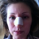 First Day after Surgery - no bruises, no pain, just discomfort because of the cast, the breathing is fine