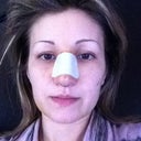 Second Day after surgery - a bit of swelling at night which has lasted for about 3 hrs