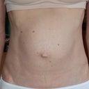 2.5 years before surgery - Front view