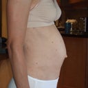 2.5 years before surgery - Side view