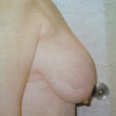 Pre op