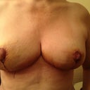 3days post op