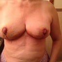 3days post op