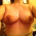 4days post op