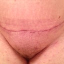 Post Op 8 weeks, front scar