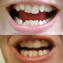 Before and After, Aligner 15