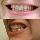 Before and After, Aligner 15 - right side