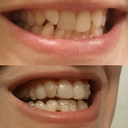 Before and After, Aligner 15 - left side