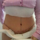 TUMMY POST OP DAY 2