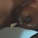 day 3 post op