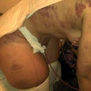 post op day 1. bent over, lots of bruising from the lipo.