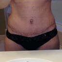 Week 4 scar