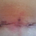 incision Healing really well feeling Great.