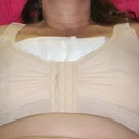 Post op day 1; sports bra I was sent home in.