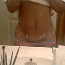 The morning after mini tummy tuck