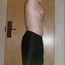 two weeks post op