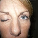 Closed eye after Botox injection