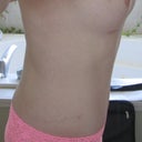 2 1/2 months (79 days) post op