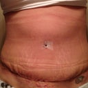 2.5 weeks po
Very Swollen