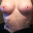 AFTER- 3 month mark (13 weeks). Dr Wolfe is the BEST. :)