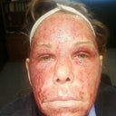 Day 2 - feeling a lot better.  Today is Friday, 1/13/12 and I have an appointment to see my doctor on Monday.
