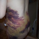 serious bruising..yikes