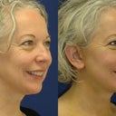 Before and After. Day 8.