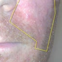 New acne-like spots