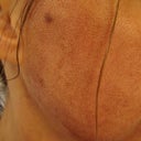 Day 2  Skin tight and starting to flake in some areas.  Still super red.