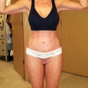 3 months post op