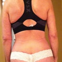 3 months post op