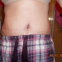 Front view still looks odd to me, seems like I don't have a waist anymore. Hoping that is the swelling