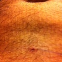 day 6 incision