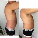 before then day 1 without swelling then how it swells back day 3-6