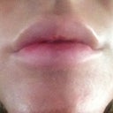 1 day after procedure