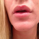 A few hours after procedure