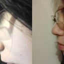 Before & After with glasses- the glasses on the 'after' photo are taped to my forehead since they aren't suppose to sit on my nose yet that's why they may appear a little bit higher than the 1st pic, but it's such a big improvement! =]