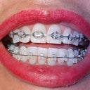 16-17 week Ortho-visit.  They added thicker wires extending to back teeth. Added chains to pull teeth back.  Not bad looking:)