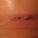 Incision under right breast