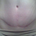 1 Year PO Front with Scar
