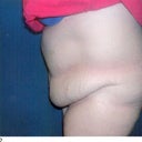 Left side 15 days before tt