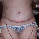 Day 1 post op