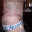 Day 1 post op
