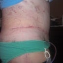 1 week post op very swollen!