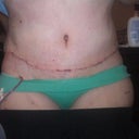 1 week post op