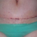 1 week post op