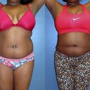 One month post op pic before and after Front