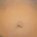 PRE OP - Herniated belly button close-up